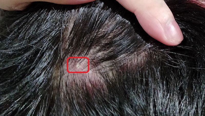 頭皮のニキビが痛い 後頭部に出来て繰り返す 毛嚢炎 毛包炎 が治らない 病気の治療 経験まとめサイト 頭皮のニキビが痛い 後頭部に出来て繰り返す 毛嚢炎 毛包炎 が治らない 病気の治療 経験まとめサイト